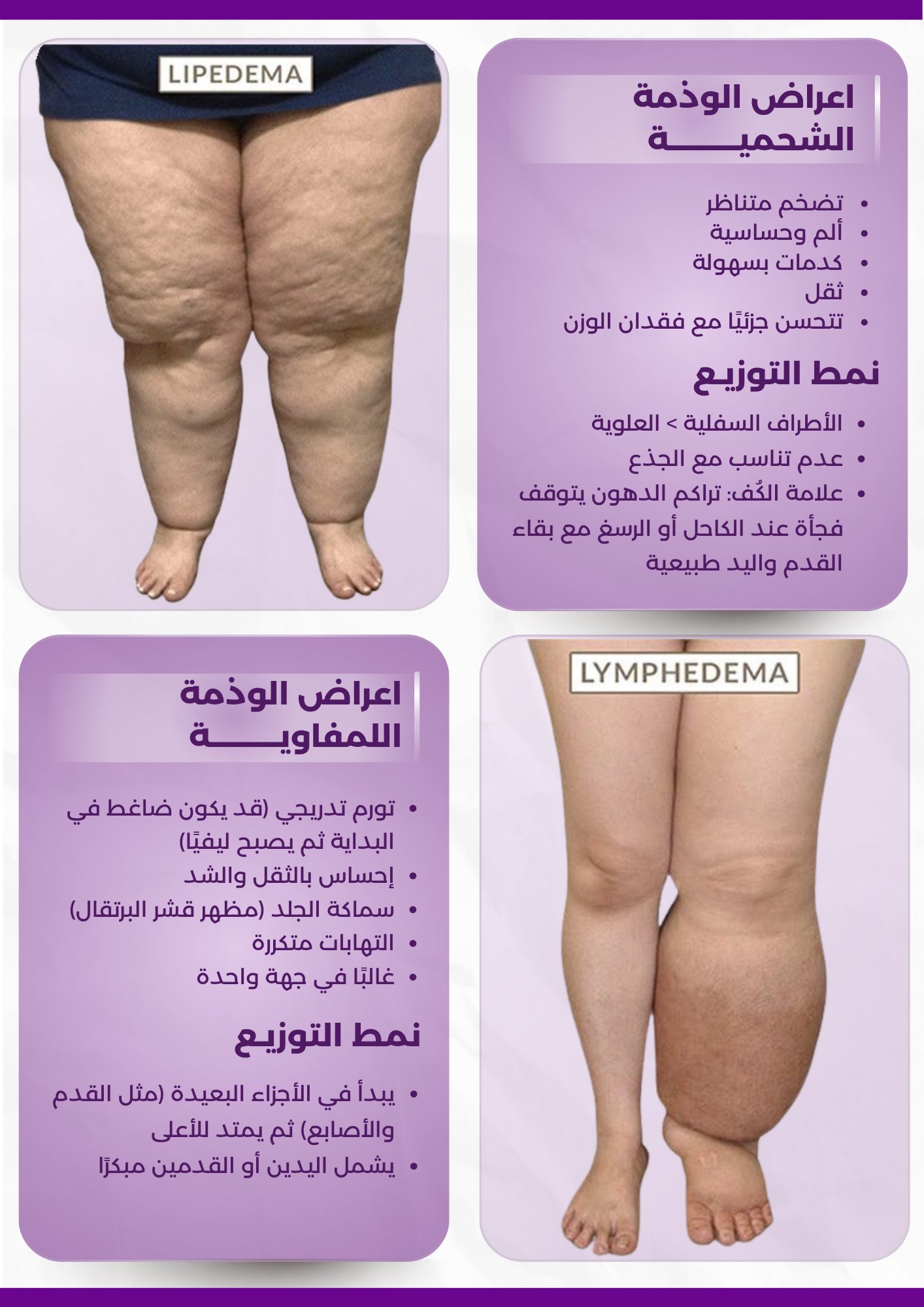 Lipedema vs Lymphedema 3