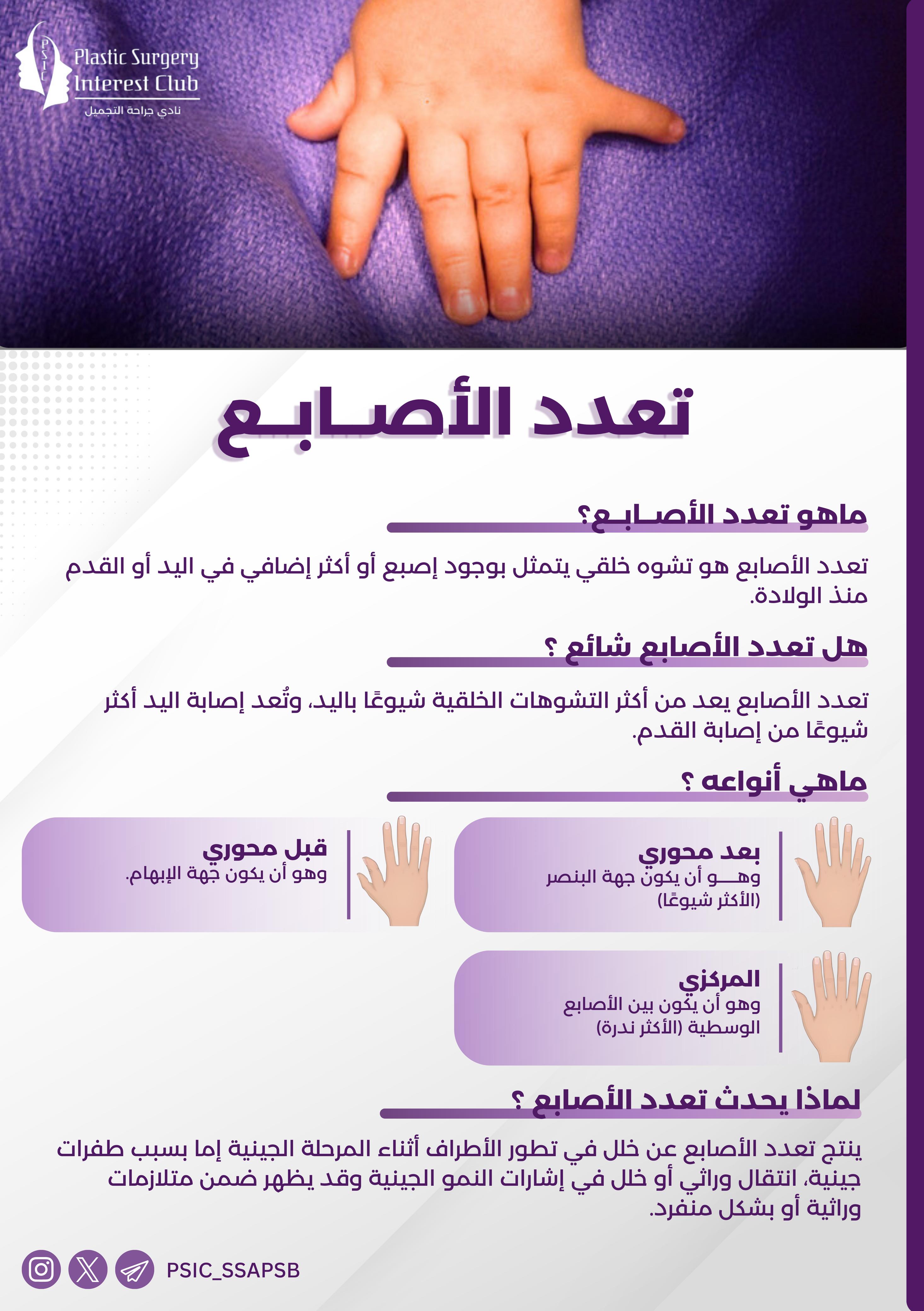 Polydactyly of Fingers 1