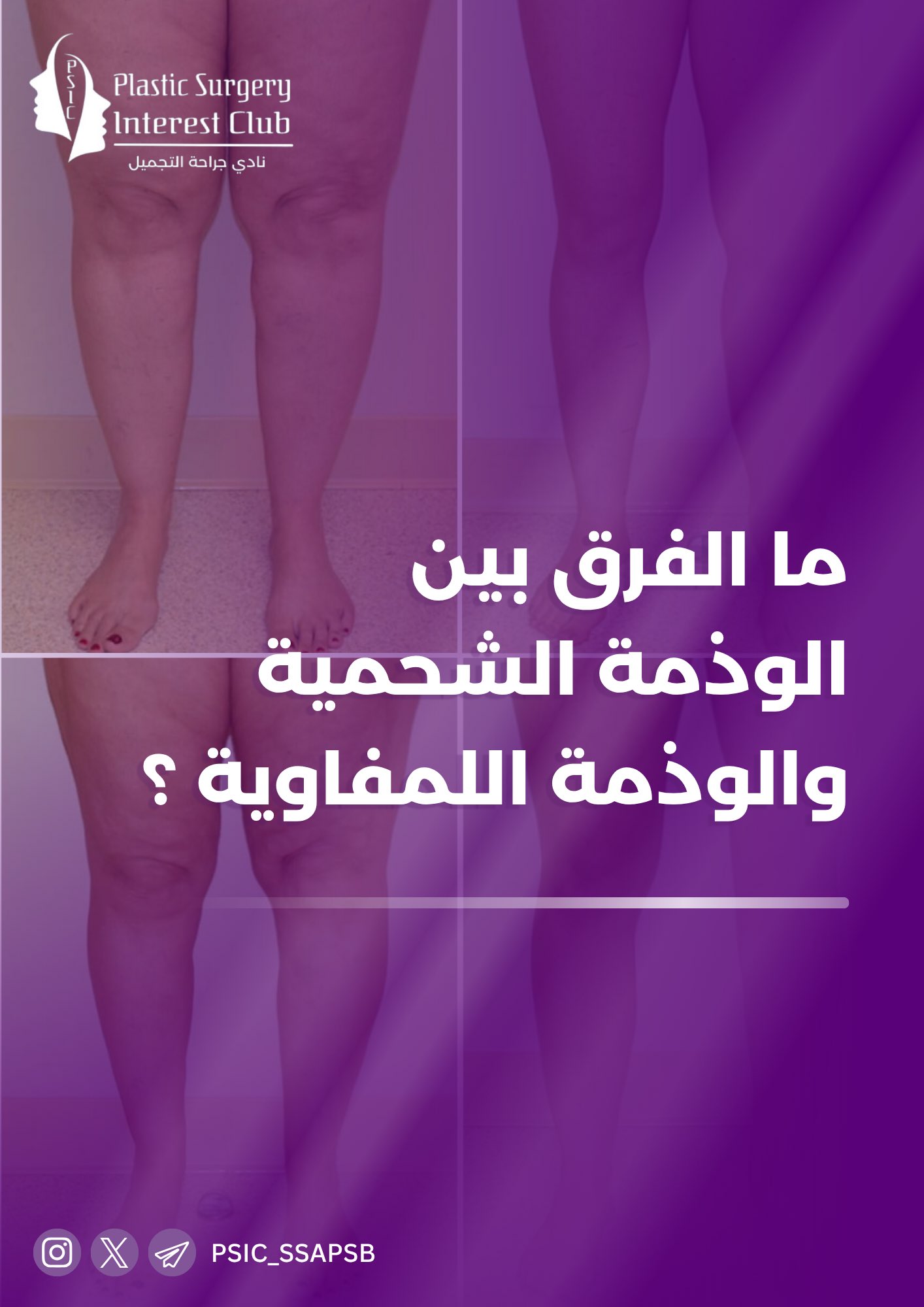 Lipedema vs Lymphedema 1