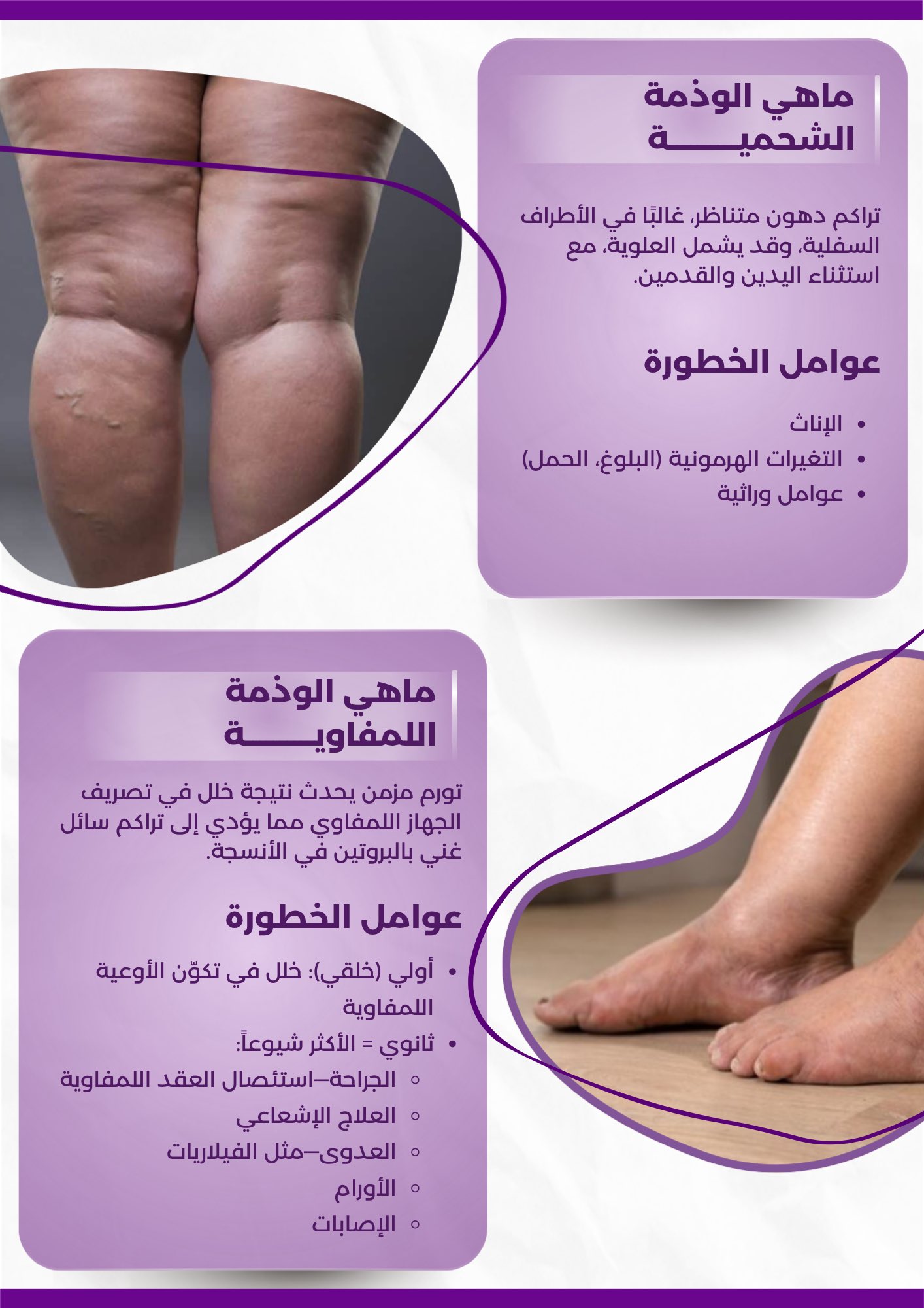 Lipedema vs Lymphedema 2